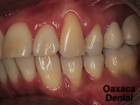 Periodontal theraphy